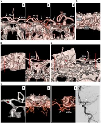 Endovascular treatment of intracranial internal carotid artery bifurcation region aneurysms